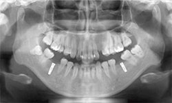 implant_image02