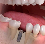 implant_image04